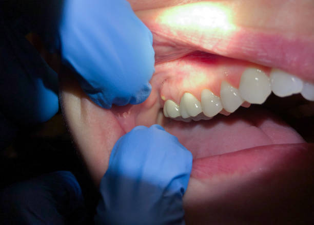 Best Emergency Dentist for Lost Fillings or Crowns in Honea Path, SC